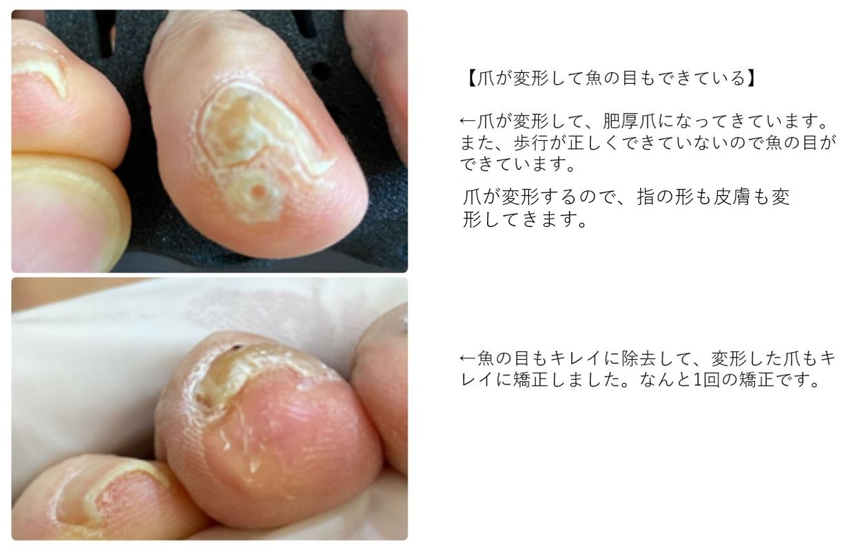 巻き爪 変形 魚の目が改善 みつばカイロプラクティック 巻き爪 変形 魚の目が改善 みつばカイロプラクティック