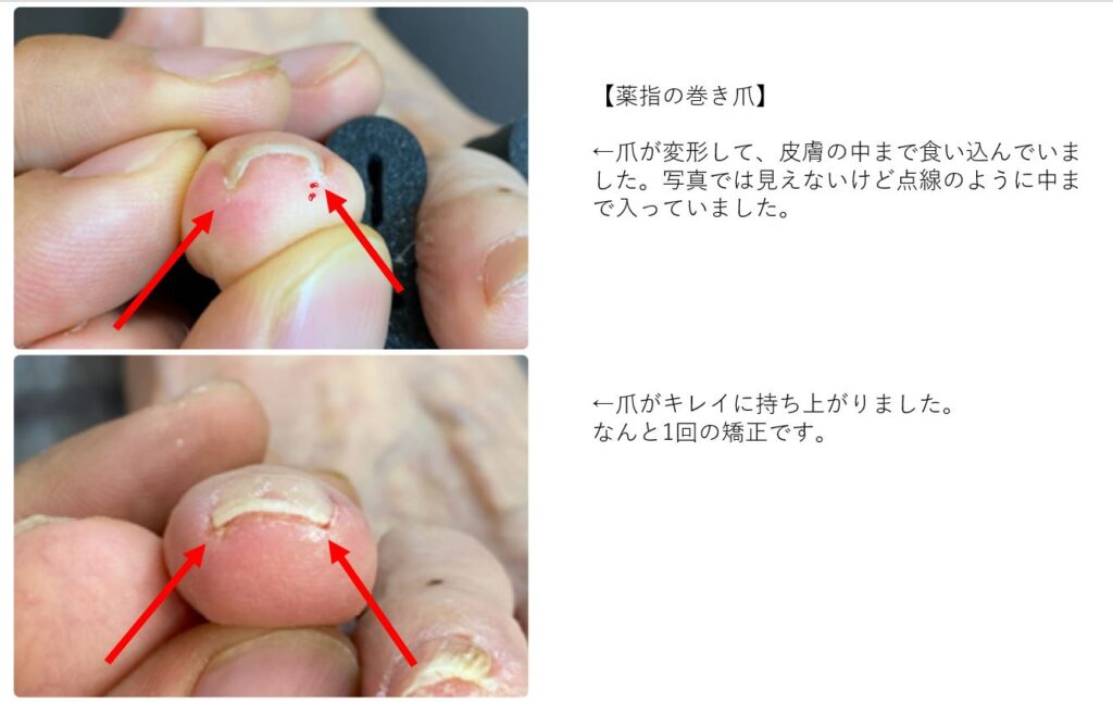 巻き爪矯正で爪がキレイに みつばカイロプラクティック