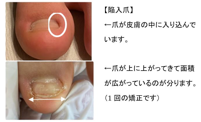 陥入爪で爪が皮膚に入り込んでいたのが 上に上がり端っこが出てきています みつばカイロプラクティック 陥入爪で爪が皮膚に入り込んでいたのが 上に上がり端っこが出てきています みつばカイロプラクティック